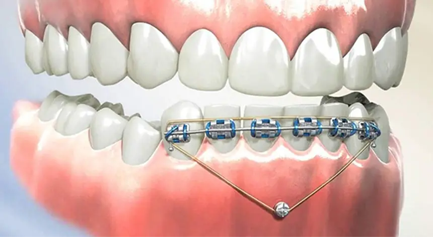 Mini-Implant-Assisted Orthodontics